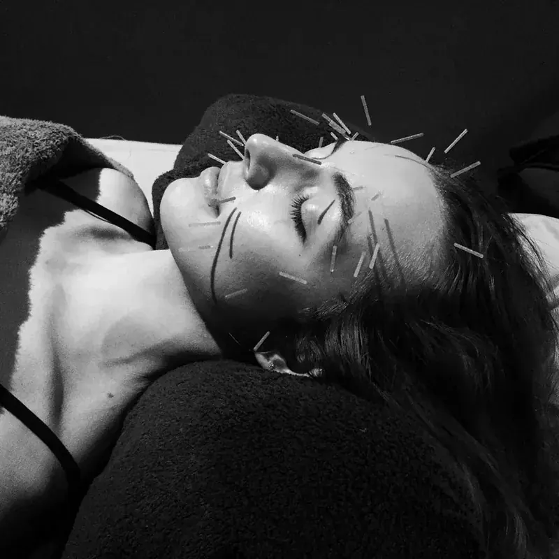 Cosmetic Acupuncture Facial at AKARA